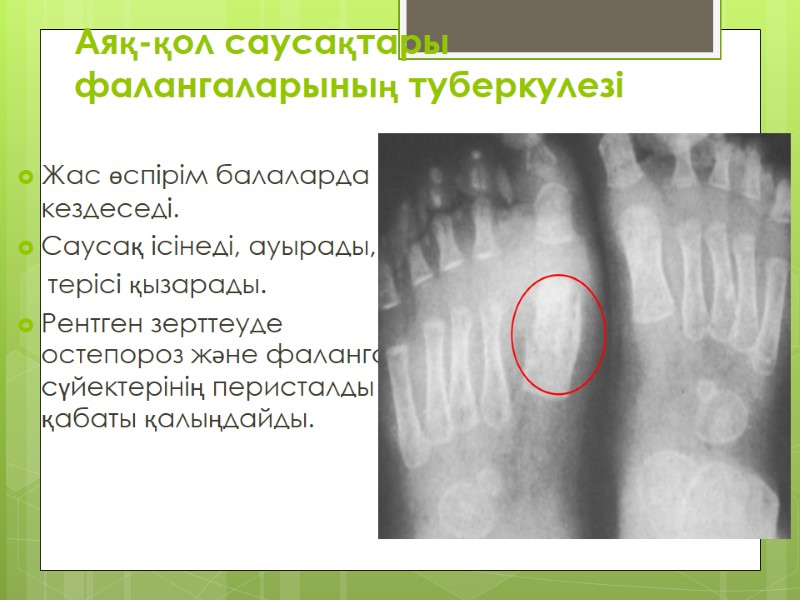 Аяқ-қол саусақтары фалангаларының туберкулезі Жас өспірім балаларда кездеседі.  Саусақ ісінеді, ауырады,  